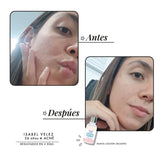 Loción secante acne